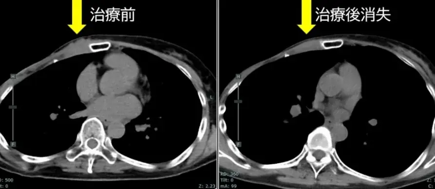 BNCTで乳がんの腫瘍消失を確認、江戸川病院報告