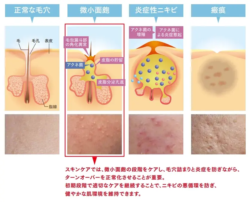 完全溶解型アゼライン酸20％配合。毛穴悩みに向き合う新美容液「CLIGRAM CLEAR ZERO AZA20」発売 画像 2