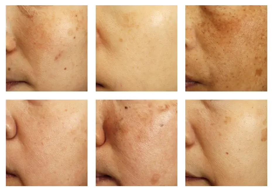 肌のメラニン、コラーゲンの量に影響を及ぼすDNA修復酵素を発見 ～美肌に重要なDNA修復酵素『NEIL1』～ 画像 2