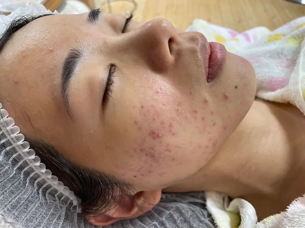 お肌に悩む若者へ 画像 1